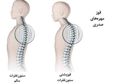 قوز کمر